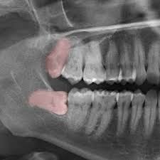 Maybe you would like to learn more about one of these? Wisdom Teeth Removal In Toronto Dr Alavi Dentistry On King