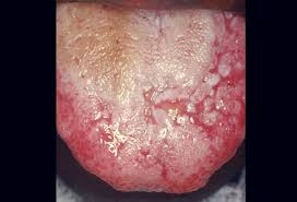 Image result for mouth ulcer on tongue)