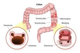 Image result for Diverticular Bleeding