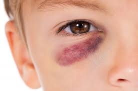 Bei einem zerstörten organ oder bei. Blut Im Auge Ursachen Symptome Und Therapie Heilpraxis