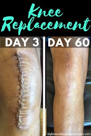 Pin On Mykneereplacementrecovery Com