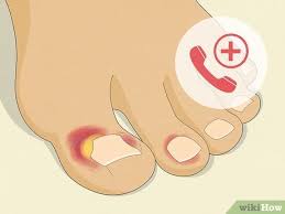 Image result for Paronychia feet