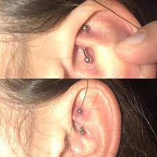 Rook Has Been Pierced Since August 10th Is This A Keloid What Can I Do To Get Rid Of The Bump If Not A Keloid Or What Can I Do To Stop