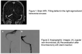 Cerebral vein and cerebral venous sinus thrombosis cerebral vein and cerebral venous sinus thromboses are blood clots that form in the veins that drain the blood from the brain called the sinuses and cerebral veins. Critical Management Of Cerebral Venous Sinus Thrombosis Cvst Concomitant With High Intracranial Pressure Icp Journal Of The Neurological Sciences