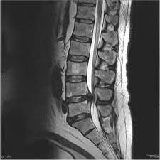 Although symptoms have poor predictive value on their own for the bottom: Cauda Equina Syndrome Symptoms And Recovery Lombafit