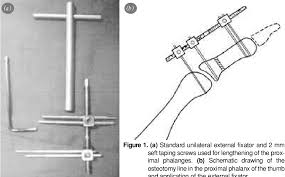We did not find results for: Pdf Lengthening Of The Phalanges By Callus Distraction In Traumatic Amputations Of The Fingers El Parmak Travmatik Amputasyonlar Nda Kallus Distraksiyonu Yontemi Ile Falangeal Uzatma Semantic Scholar