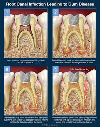 Maybe you would like to learn more about one of these? Confusing Tooth Pain