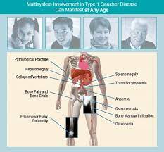 Gaucher Disease Physiopedia