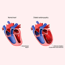 Image result for Cardiomyopathy
