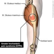 The upper part of the leg is the thigh bone. Why Does The Outside Of My Hip Hurt What To Do About It Lakeview Physio In Calgary Ab