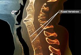 Visual Guide To Ankylosing Spondylitis