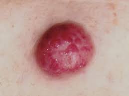 Image result for Merkel Cell Carcinoma