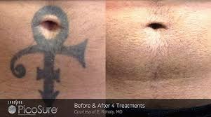 Im desperate to remove my tattoo i got wen i was 17. Learn About The Benefits Of The Picosure Tattoo Removal System