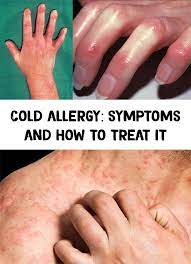 Cold Allergy Symptoms And How To Treat It Cold Or Allergies How To Treat Allergies Cold Symptoms