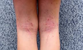 Image result for allergy rash on the legs