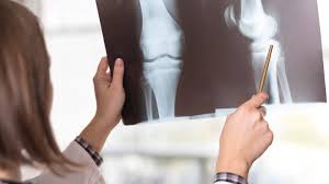 Will I Need Knee Surgery For Osteoarthritis Everyday Health