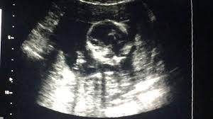 Schluckauf Beim Baby Diese Tipps Helfen Echte Mamas
