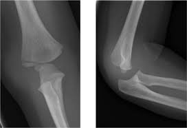 This article discusses a lateral epicondyle fracture of the humerus. The Elbow