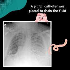 Image result for Small Caliber Chest Tube