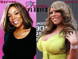 Those procedures included nose job, breast implants, and some fillers injection. Toni Braxton Bsmith101 S Weblog