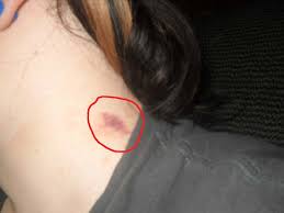 Your hickey is probably a myriad of colors from black to red so go for colors. How To Hide A Hickey Get Rid Hickeys Fast Overnight Seconds Instantly With Makeup Coin Spoon Toothpaste