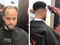 This gradual reduction in hair typically begins with thinning on the top and sides. Man Weaves A Game Changer For Balding Men Cash For 2 5 Billion Black Haircare Industry Npr