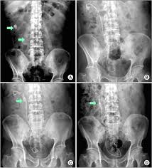 X Ray Images Of The Kidney Ureter And Bladder A Pretreatment Download Scientific Diagram