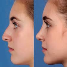 If you have a lung injury or illness, your doctor may tell you you need to have lung surgery as part of your treatment. What Is Plastic Surgery American Society Of Plastic Surgeons