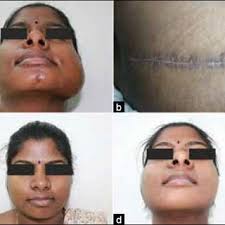 a) Immediate postoperative view showing over correction to compensate...