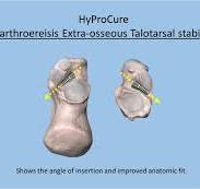 The HyProCure Advantage - GraMedica