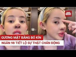 Ngân 98 băng bó kín mặt, tháo mũi giữa đêm vì nhiễm trùng nặng