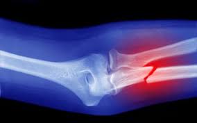 Buckle fractures of the distal radius represent about 50% of pediatric fractures of the wrist. Understanding What Buckle Fractures Are In Children