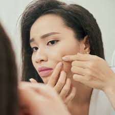 Menyentuh jerawat secara langsung akan memperparah kemerahan dan radang. Cara Jitu Hilangkan Bekas Jerawat Dengan Natur E Natur E
