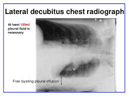 Lateral decubitus films can help to quantify the amount of fluid and determine. Pleural Effusion Dr Mahesh