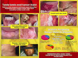 V tompok putih atau merah pada bahagian dalam mulut. Kanser Mulut Pusat Sumber Dan Pendidikan Kanser Care