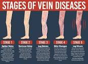 Varicose Vein Treatments - What are the Best?