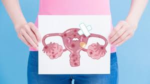Kondisi penebalan dinding rahim yang tak wajar inilah yang disebut hiperplasia endometrium. Penyebab Penebalan Dinding Rahim Yang Perlu Diwaspadai Kumparan Com