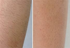 It works best for people with darker hair and lighter skin since the laser looks for the color contrast. Laser Hair Removal The Aesthetics Center The Aesthetics Center