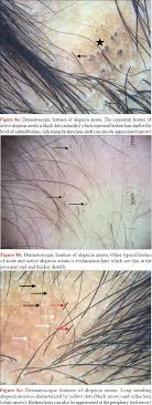 The opening to the vagina, the introitus, narrows in the absence of regular sexual activity, and heterosexual women becoming sexually active after a time of abstinence can suffer pain and difficulty with penetration. Indian Journal Of Dermatology Venereology And Leprology Hair Manifestations Of Endocrine Diseases A Brief Review