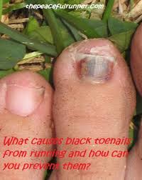 Black Toenails From Running What Causes Them And How Can You Prevent Them