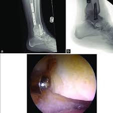 A fracture of the lateral malleolus above the syndesmosis joint constitutes a type c weber fracture, while below the syndesmosis trimalleolar fracture is the fracture of the ankle involving three bones in the lower leg, namely medial malleolus, lateral malleolus, and the posterior part of the tibial bone. A Weight Bearing Lateral View Radiograph Of Left L Ankle Showing Download Scientific Diagram