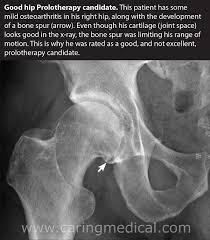Hip revision (a repeat hip replacement) surgery involves replacing your artificial hip joint if it's become loose, infected or worn out. Alternatives To Hip Replacement The Evidence For Non Surgical Treatments Caring Medical Florida