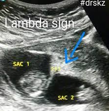 A lot of languages don't even use the term; Lambda Or Twin Peak Sign Ultrasound Guided Tips Facebook