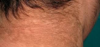 Por Que Tienes Manchas Oscuras En El Cuello Clinica Internacional