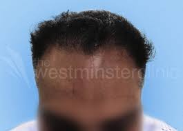 Thailand is a hair loss clinic absolutely devoted to hair loss treatment, hair transplant, hair restoration, fue (follicular unit excision), prp injection for hair loss, laser cap ปลูกผมfue ปลูกคิ้ว ห. Asian Hair Transplants