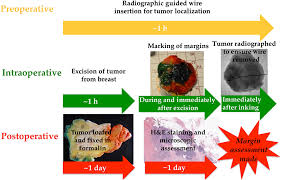 Clear margins in any cancer surgery means that in the sample of tissue that they are talking about the cancer does not extend to the edge of the sample. Molecular Dyes Used For Surgical Specimen Margin Orientation Allow For Intraoperative Optical Assessment During Breast Conserving Surgery