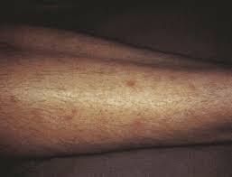Often the cause of the arm rash is unknown. When A Patient Presents With A Lower Extremity Rash Podiatry Today