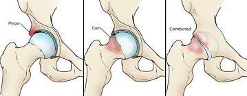 Please find downloadable legal & privacy documents at the bottom of this page. Femoroacetabular Impingement Orthoinfo Aaos