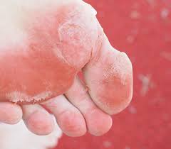 Image result for mykoza nehtů