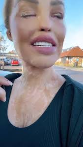 Post-Surgery Gym Recovery Session Update